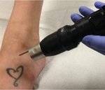 tattoo removal