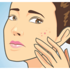 clogged pore