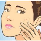 acne woman