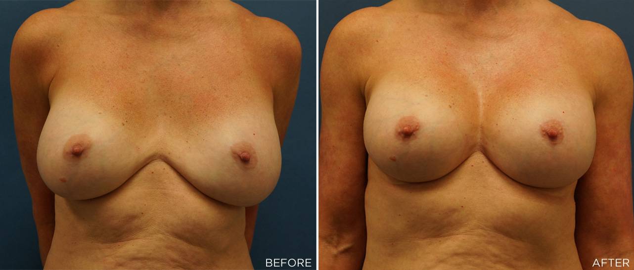 Patient F - Implant Revision