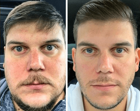 before and after male face showing improvement in puffiness and redness after he quit drinking alcohol