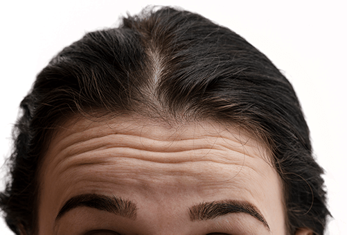 forhead lines
