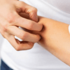 dermatitis