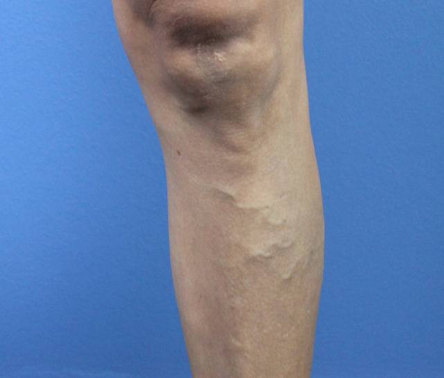patient A phlebectomy left leg before