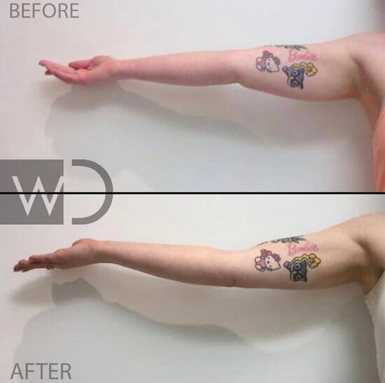 coolsculpting 2