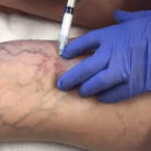 sclerotherapy vein removal