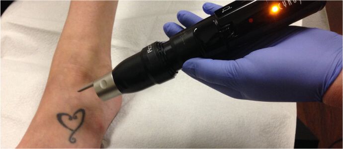 number of laser tattoo removal treatments needed