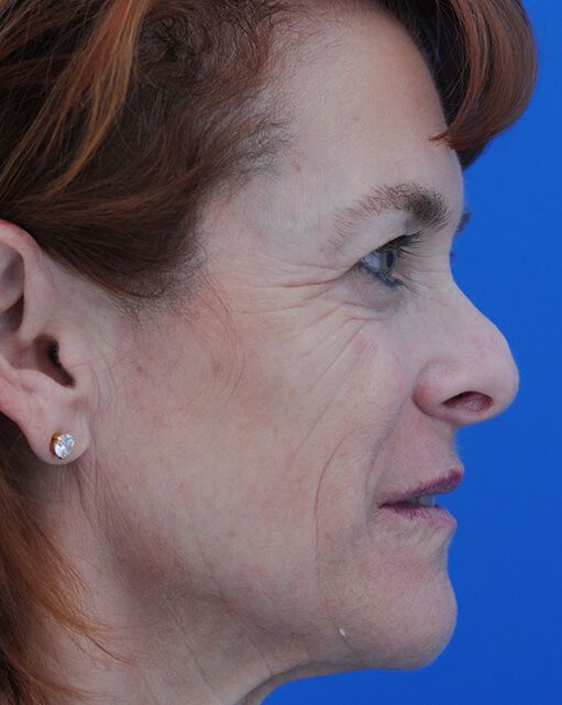 Preop Rev Rhinoplasty 3