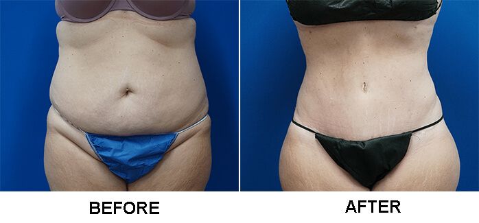 before and after belly button change