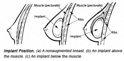 breast implant position