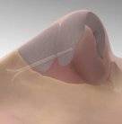 latera implant