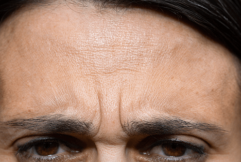 frown lines