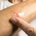 minor burn close up
