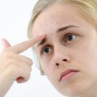 acne issues