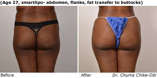 Patient Q liposuction side view Before and After