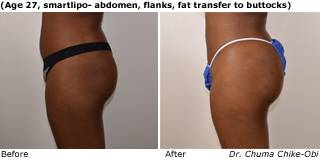 Patient Q liposuction up view Before and After