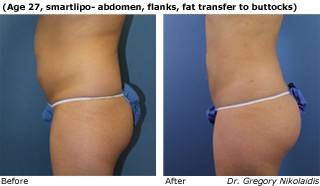 Patient C SmartLipo Before and After