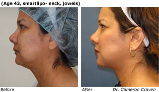 Patient C SmartLipo Before and After