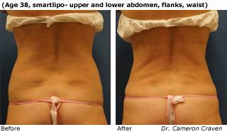 Patient F liposuction side view Before and After