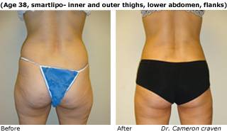 Patient C SmartLipo side view Before and After