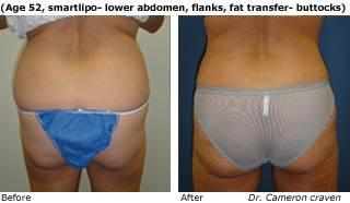 Patient C SmartLipo side view Before and After