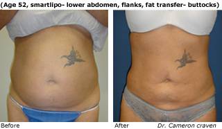 Patient C SmartLipo Before and After