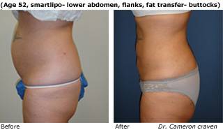 Patient C SmartLipo up view Before and After