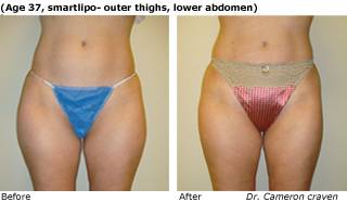 Patient R liposuction Before and After