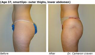 Patient R liposuction up view Before and After