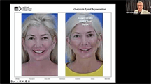 Blepharoplasty and Brow Lift Webinar