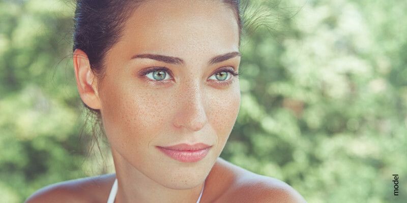 melasma flare-up