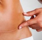 scar removal