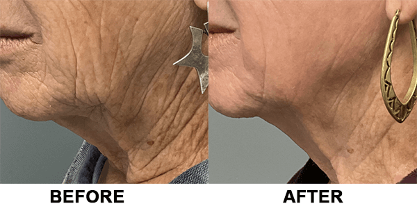 before and after ultraclear woman neck side view