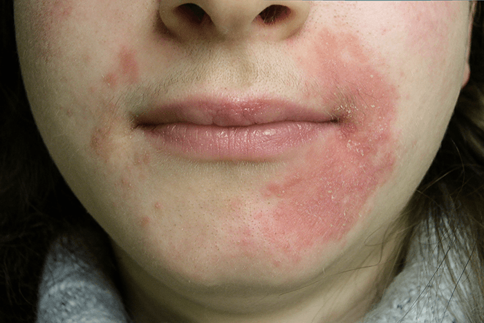 close up image of active perioral dermatitis on female patient