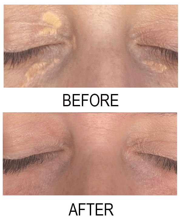 patient before and after bleomycin injection for xanthelasma on eyelid