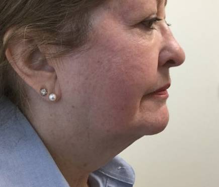 kybella side after