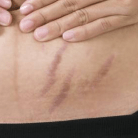 stretch marks
