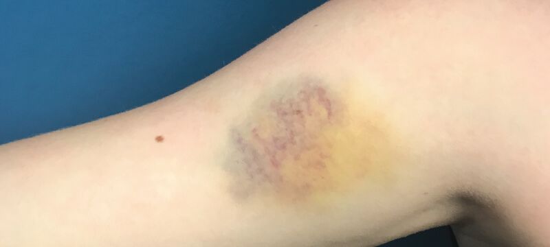moderate arm bruise
