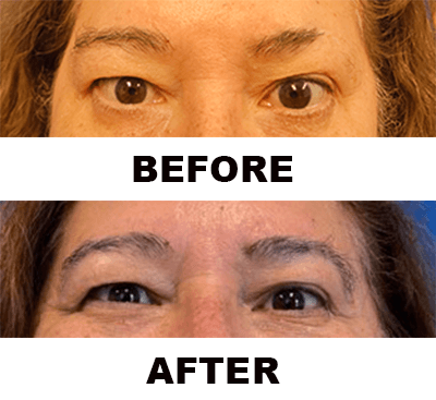 Before and after eyebrow hair transplant, front view