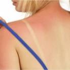 sunburn