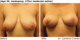 patient R breast augmentation front