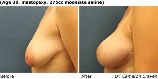 Patient R Silicone Before and After