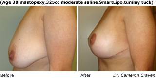 Patient T Silicone Before and After