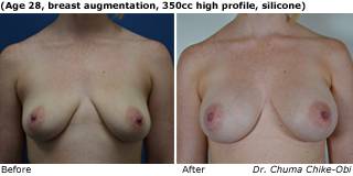 patient C breast augmentation front