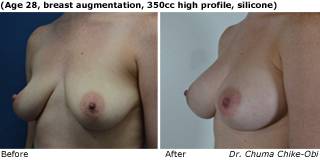 patient C breast augmentation quarter