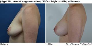patient C breast augmentation side