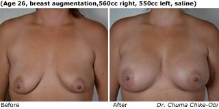 patient l breast augmentation front