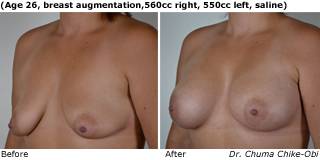 patient l breast augmentation qurter