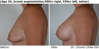 Patient l Silicone Before and After