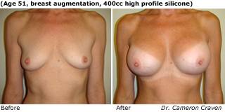 patient q breast augmentation front
